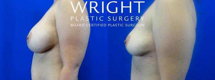 Before & After Breast Implant Removal Case 9 Left Side View in Little Rock, Arkansas