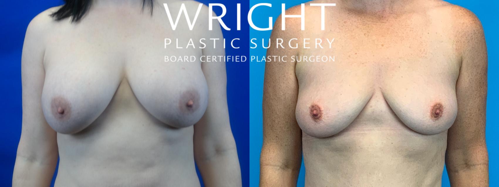 Before & After Breast Implant Removal Case 94 Front View in Little Rock, Arkansas