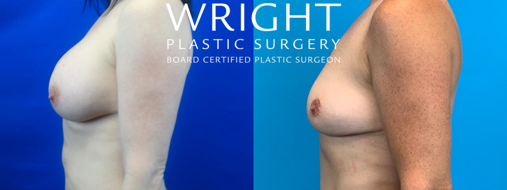 Before & After Breast Implant Removal Case 94 Left Side View in Little Rock, Arkansas