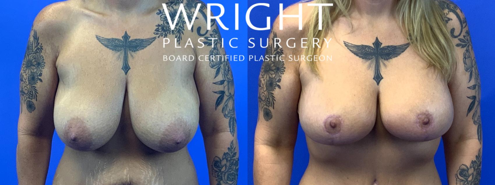 Before & After Breast Lift Case 107 Front View in Little Rock, Arkansas