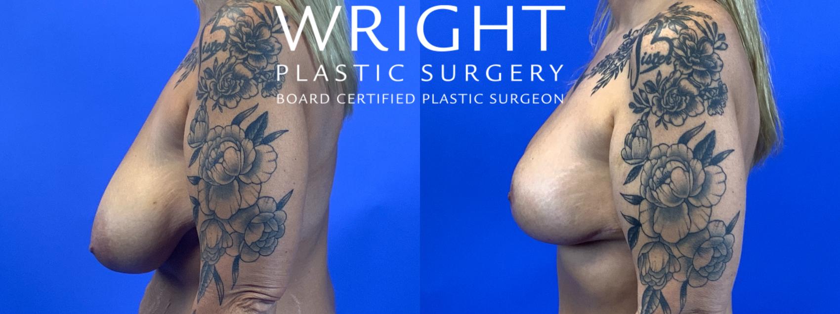 Before & After Breast Lift Case 107 Left Side View in Little Rock, Arkansas