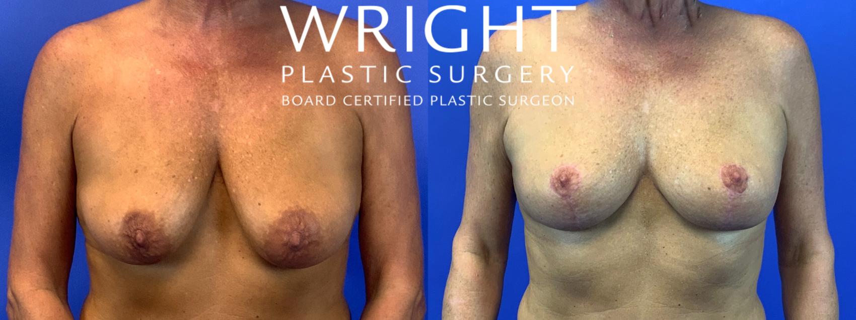 Before & After Breast Lift Case 116 Front View in Little Rock, Arkansas