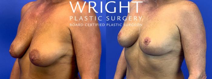 Before & After Breast Lift Case 116 Left Oblique View in Little Rock, Arkansas