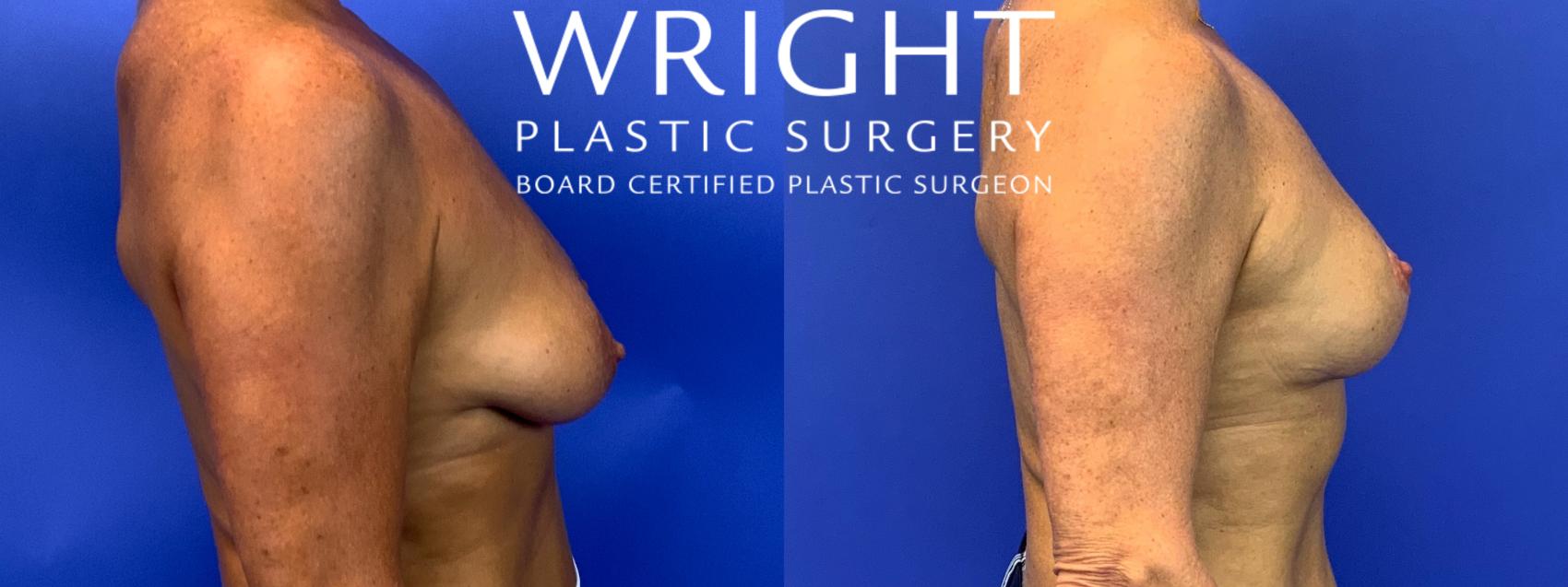 Before & After Breast Lift Case 116 Right Side View in Little Rock, Arkansas