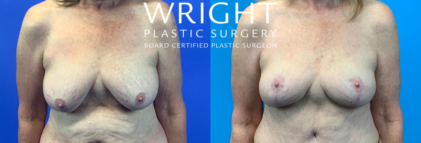 Before & After Breast Lift Case 135 Front View in Little Rock, Arkansas