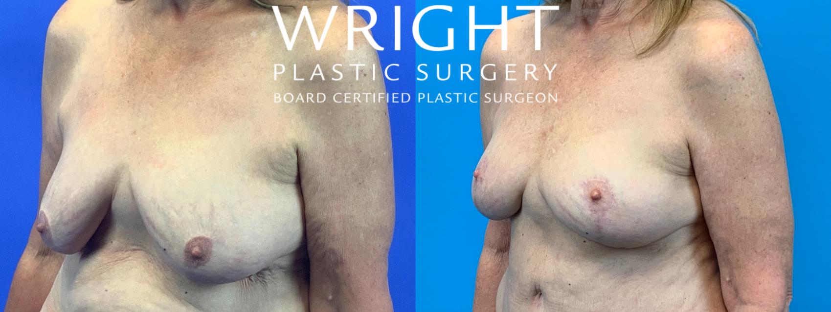 Before & After Breast Lift Case 135 Left Oblique View in Little Rock, Arkansas
