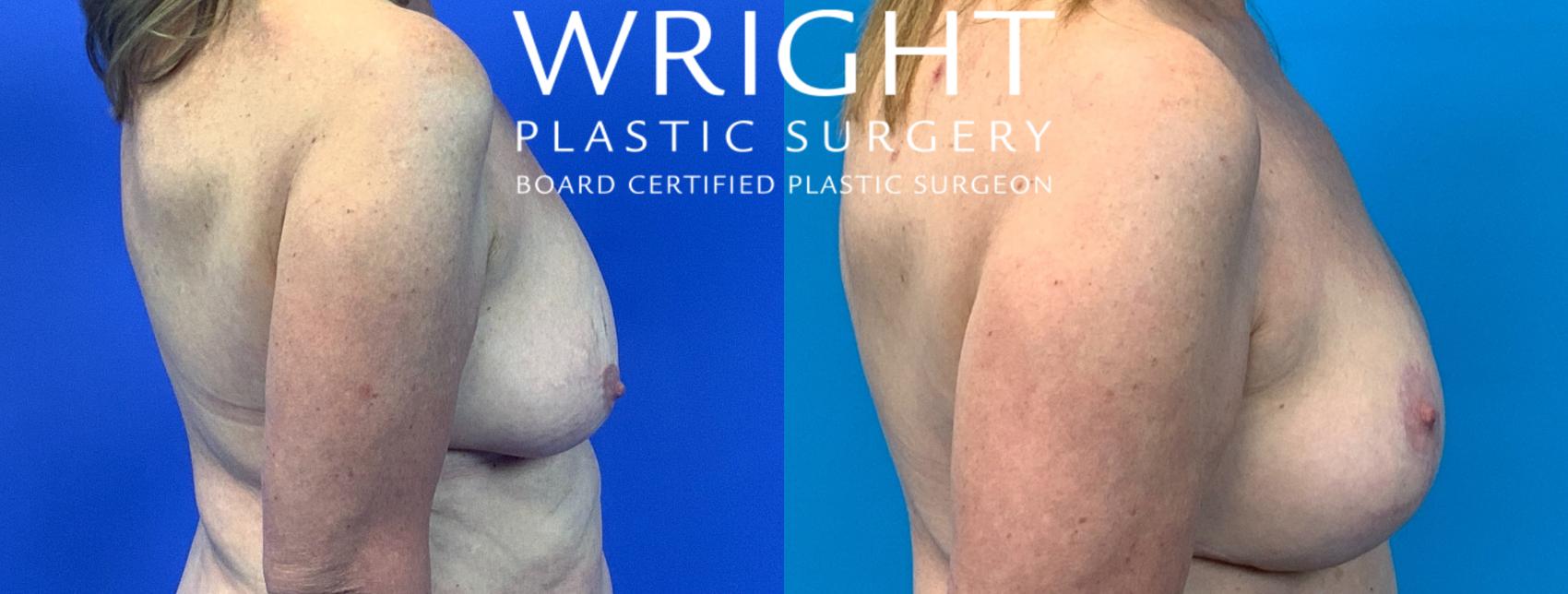 Before & After Breast Lift Case 135 Right Side View in Little Rock, Arkansas