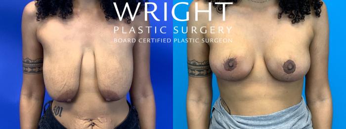 Before & After Breast Lift Case 182 Front View in Little Rock, Arkansas