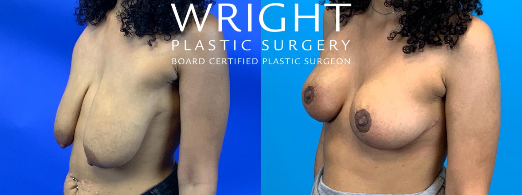 Before & After Breast Lift Case 182 Left Oblique View in Little Rock, Arkansas