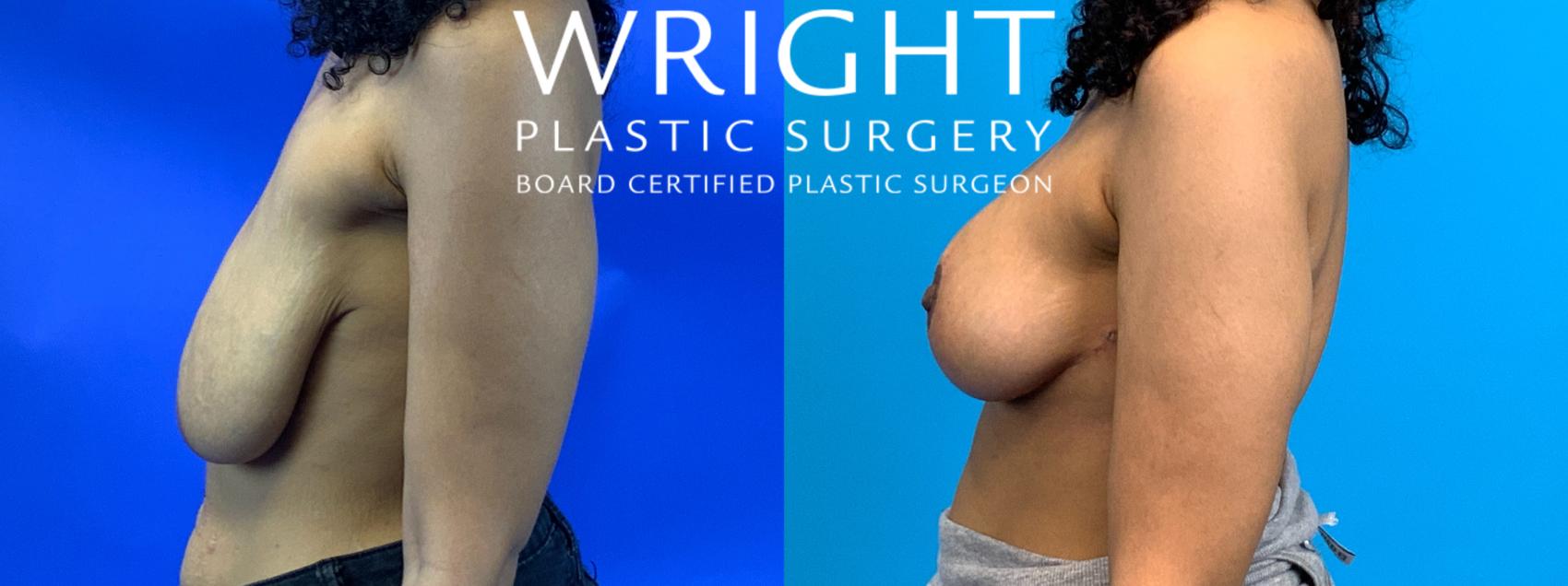 Before & After Breast Lift Case 182 Left Side View in Little Rock, Arkansas