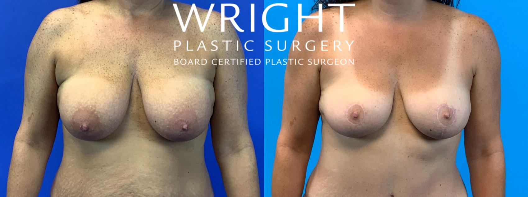 Before & After Breast Lift Case 195 Front View in Little Rock, Arkansas