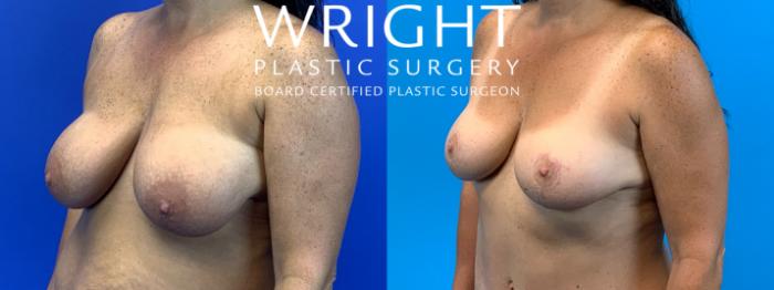 Before & After Breast Lift Case 195 Left Oblique View in Little Rock, Arkansas