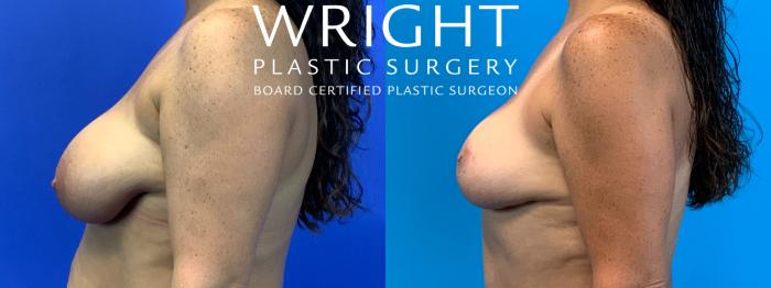 Before & After Breast Lift Case 195 Left Side View in Little Rock, Arkansas