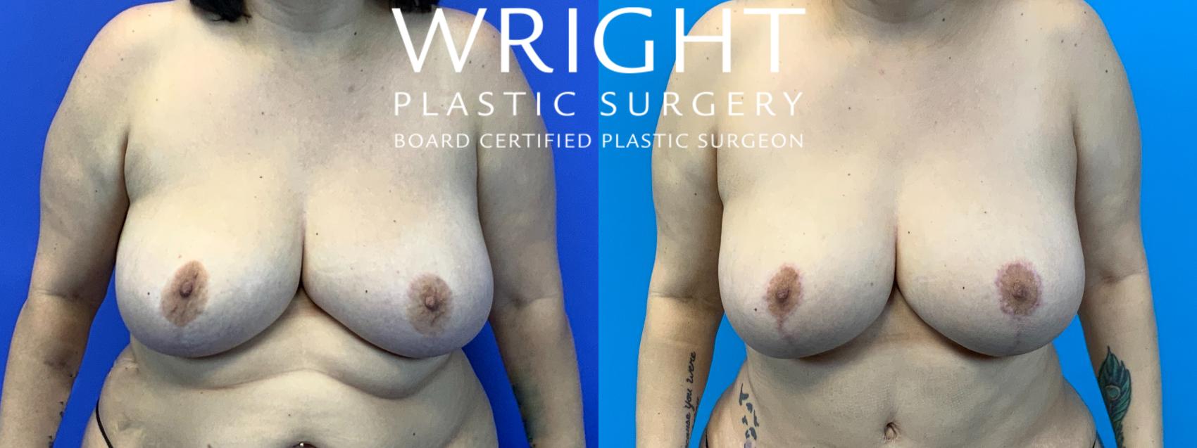 Before & After Breast Lift Case 205 Front View in Little Rock, Arkansas