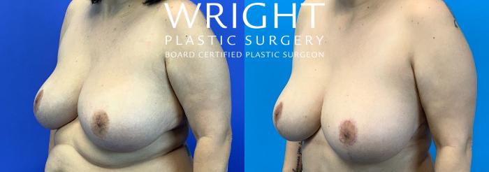 Before & After Breast Lift Case 205 Left Oblique View in Little Rock, Arkansas