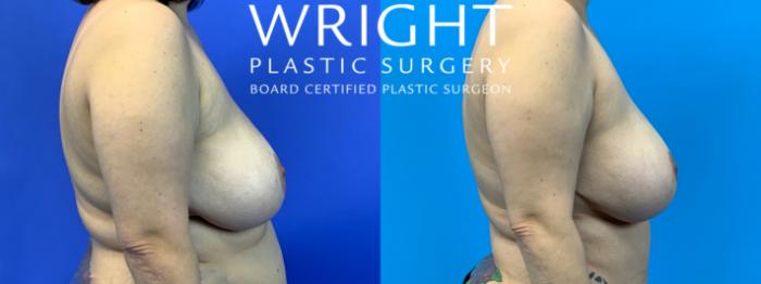 Before & After Breast Lift Case 205 Right Side View in Little Rock, Arkansas