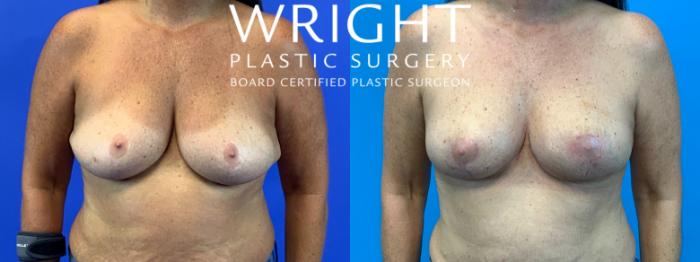 Before & After Breast Lift Case 231 Front View in Little Rock, Arkansas