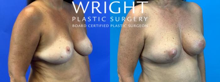 Before & After Breast Lift Case 231 Right Oblique View in Little Rock, Arkansas