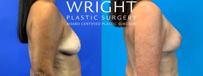 Before & After Breast Lift Case 231 Right Side View in Little Rock, Arkansas