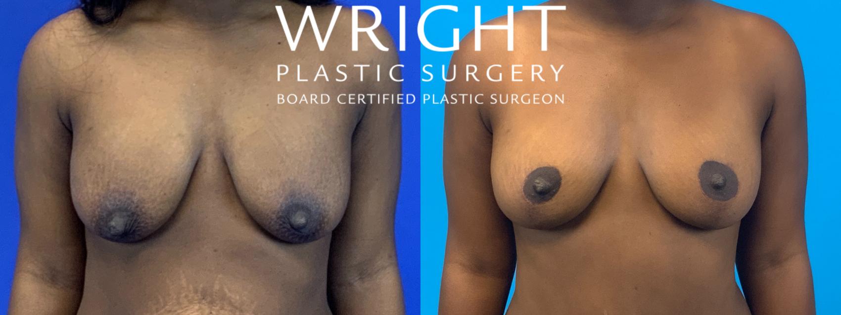 Before & After Breast Lift Case 239 Front View in Little Rock, Arkansas