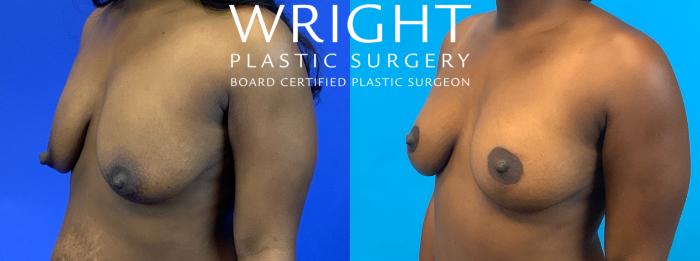 Before & After Breast Lift Case 239 Left Oblique View in Little Rock, Arkansas