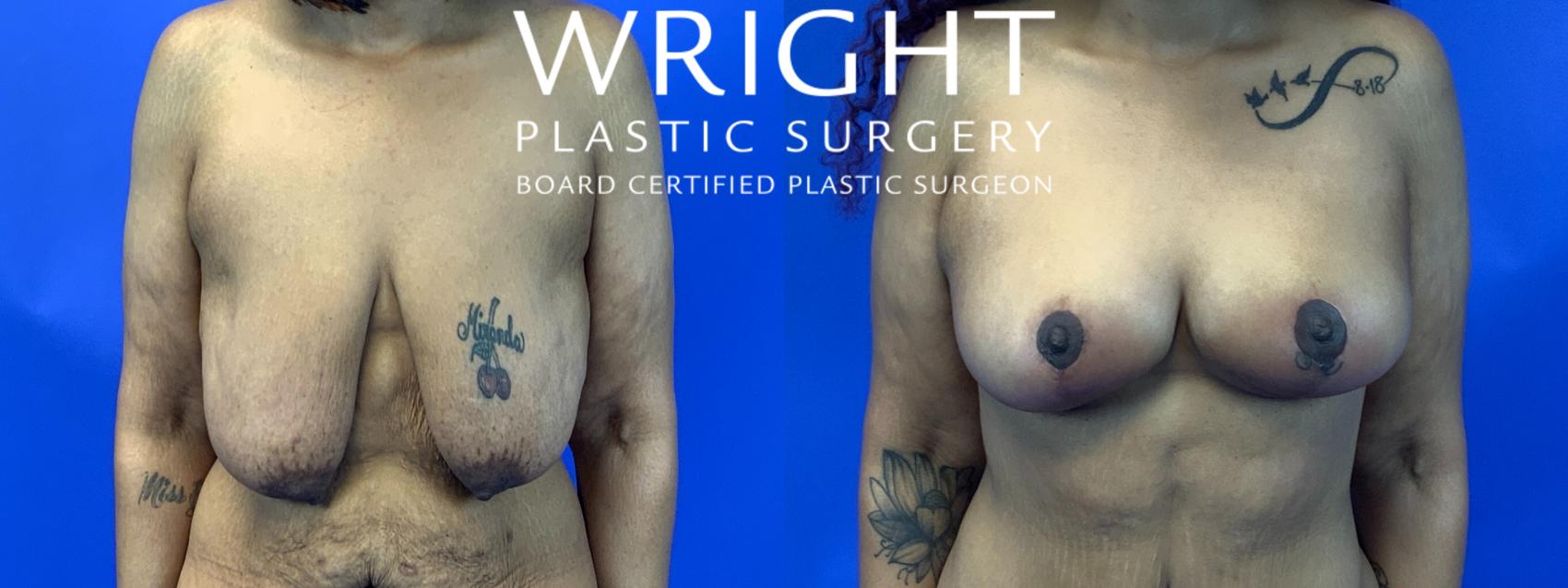 Before & After Breast Lift Case 253 Front View in Little Rock, Arkansas