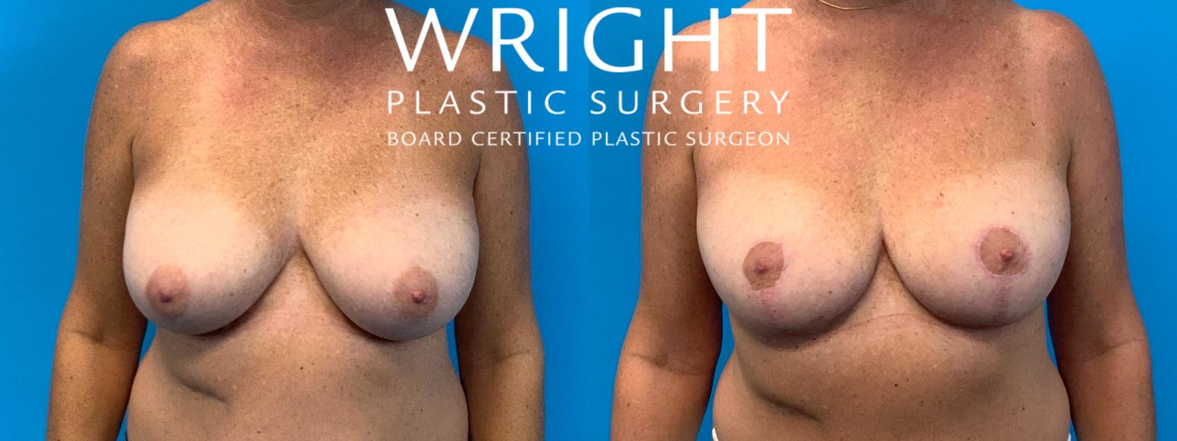 Before & After Breast Lift Case 284 Front View in Little Rock, Arkansas
