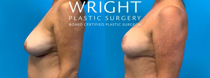 Before & After Breast Lift Case 284 Left Side View in Little Rock, Arkansas