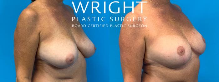 Before & After Breast Lift Case 284 Right Oblique View in Little Rock, Arkansas