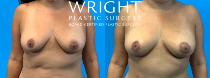 Before & After Breast Lift Case 291 Front View in Little Rock, Arkansas
