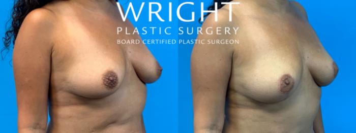 Before & After Breast Lift Case 291 Right Oblique View in Little Rock, Arkansas