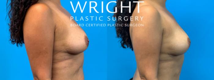 Before & After Breast Lift Case 291 Right Side View in Little Rock, Arkansas