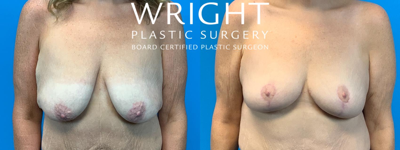 Before & After Breast Lift Case 304 Front View in Little Rock, Arkansas