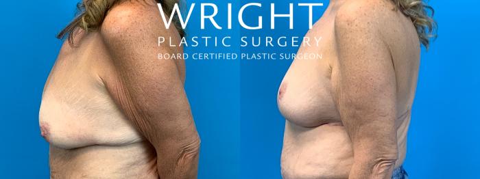 Before & After Breast Lift Case 304 Left Side View in Little Rock, Arkansas