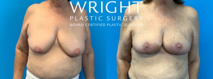 Before & After Breast Lift Case 336 Front View in Little Rock, Arkansas
