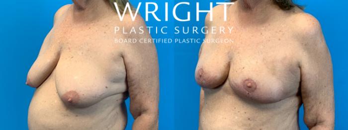 Before & After Breast Lift Case 336 Left Oblique View in Little Rock, Arkansas
