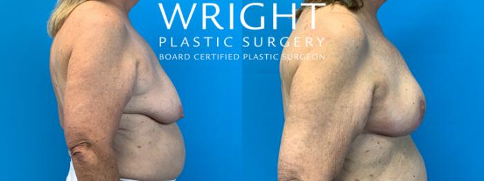 Before & After Breast Lift Case 336 Right Side View in Little Rock, Arkansas