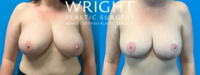Before & After Breast Lift Case 353 Front View in Little Rock, Arkansas