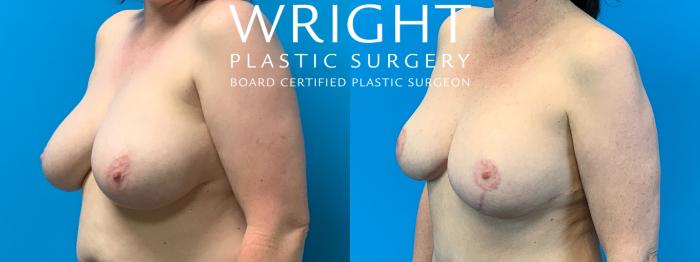 Before & After Breast Lift Case 353 Left Oblique View in Little Rock, Arkansas