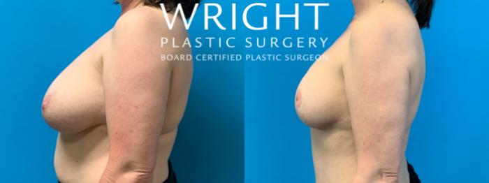 Before & After Breast Lift Case 353 Left Side View in Little Rock, Arkansas
