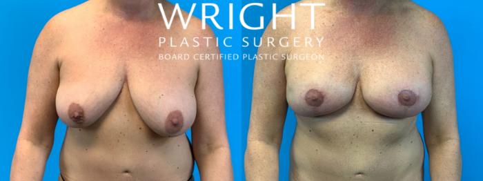 Before & After Breast Lift Case 365 Front View in Little Rock, Arkansas