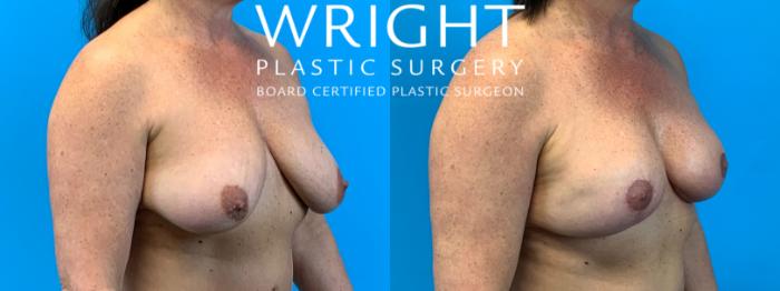 Before & After Breast Lift Case 365 Right Oblique View in Little Rock, Arkansas