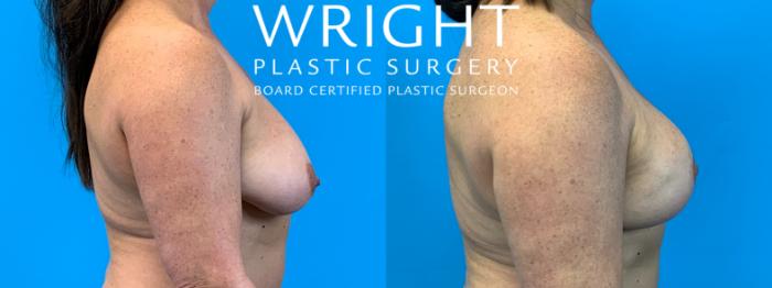 Before & After Breast Lift Case 365 Right Side View in Little Rock, Arkansas