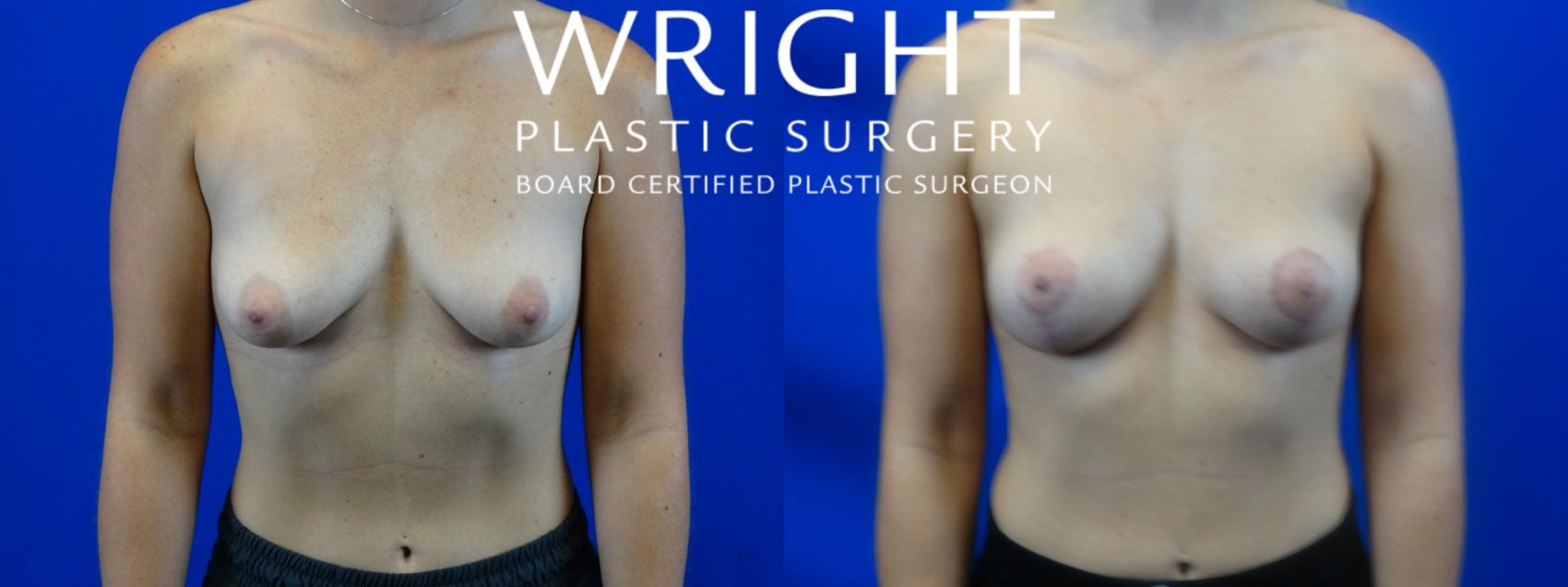 Before & After Breast Lift Case 4 Front View in Little Rock, Arkansas