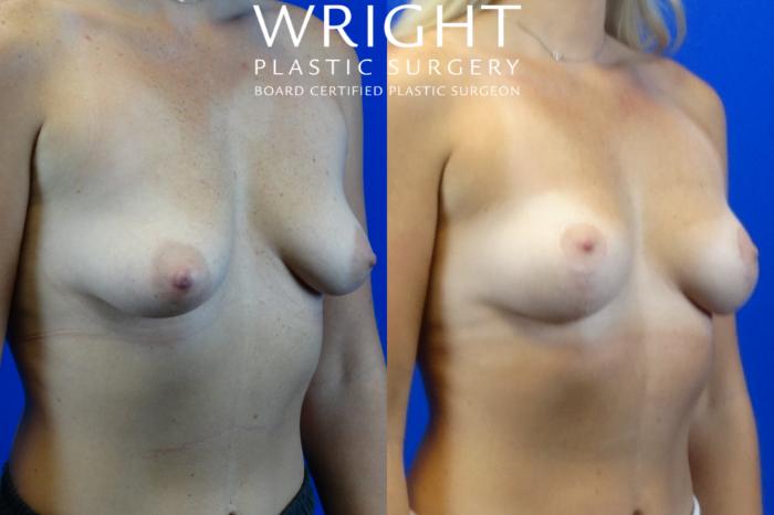 Before & After Breast Lift Case 4 Right Oblique View in Little Rock, Arkansas