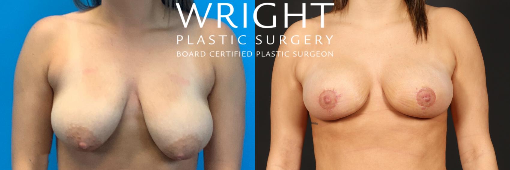 Before & After Breast Lift Case 425 Front View in Little Rock, Arkansas
