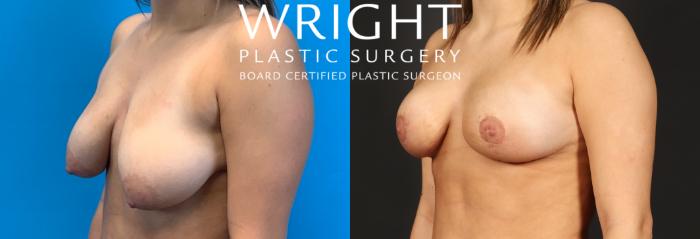 Before & After Breast Lift Case 425 Left Oblique View in Little Rock, Arkansas