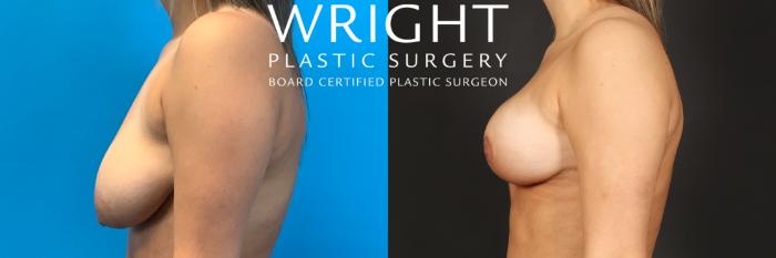 Before & After Breast Lift Case 425 Left Side View in Little Rock, Arkansas