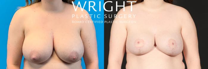 Before & After Breast Lift Case 433 Front View in Little Rock, Arkansas