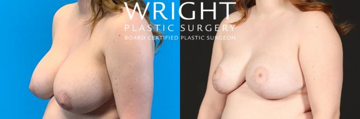 Before & After Breast Lift Case 433 Left Oblique View in Little Rock, Arkansas